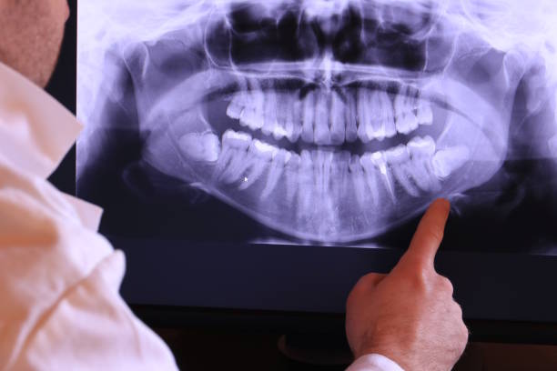 Best Emergency Dentist for Lost Fillings or Crowns in East Islip, NY