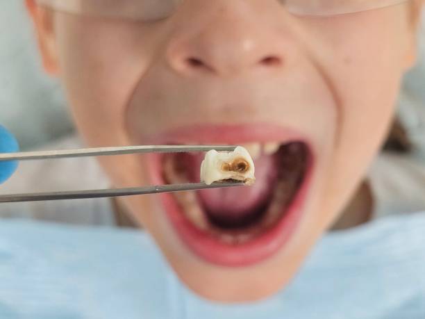 Best Emergency Dentist for Lost Fillings or Crowns in East Islip, NY